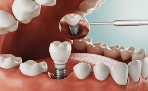 Indonesia Dental Implant Market Outlook to 2030