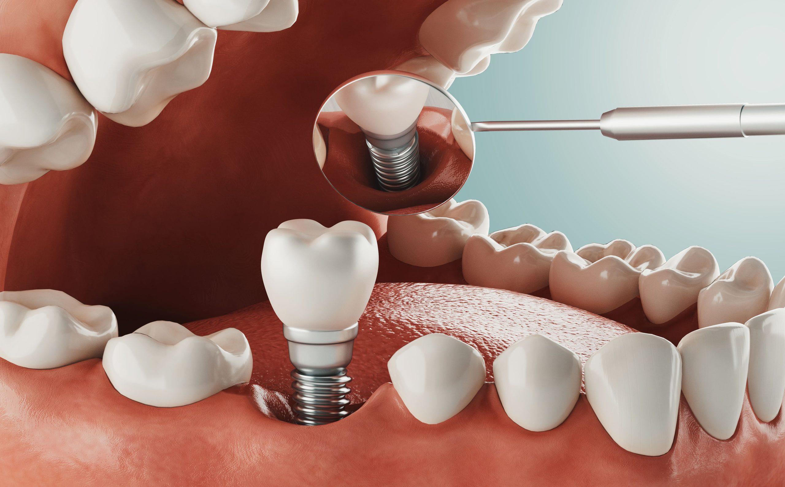 Indonesia Dental Implant Market Outlook to 2030 Indonesia-Dental-Implant-Market-Outlook-to-2030-scaled
