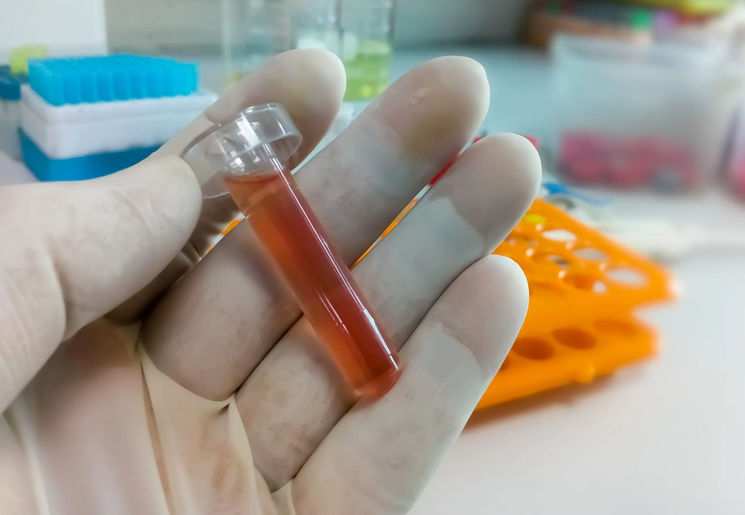 USA Lipid Profile Testing Market Outlook 2030 biochemist-hold-pleural-fluid-sample-with-laboratory-background-which-is-ready-biochemical-test-scaled