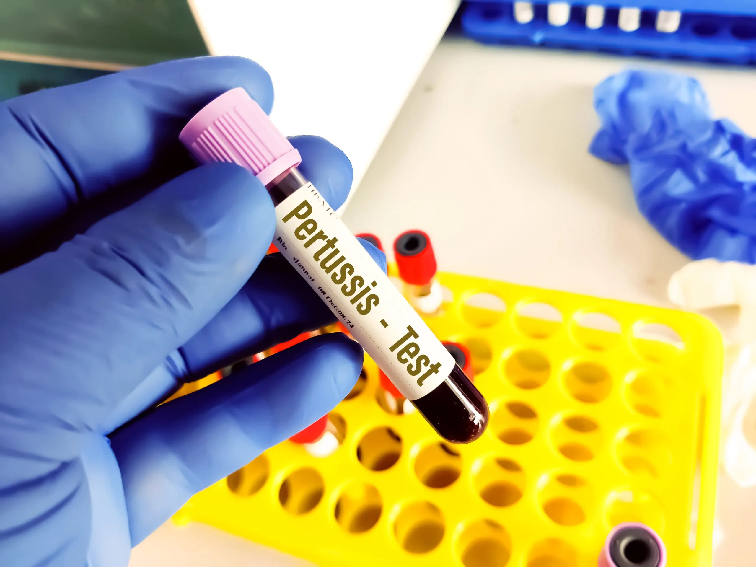 UAE Lipid Profiles Testing Market Outlook 2030 biological-specimen-blood-vacuum-tube-pathological-analysis-medical-laboratory-testing-scaled