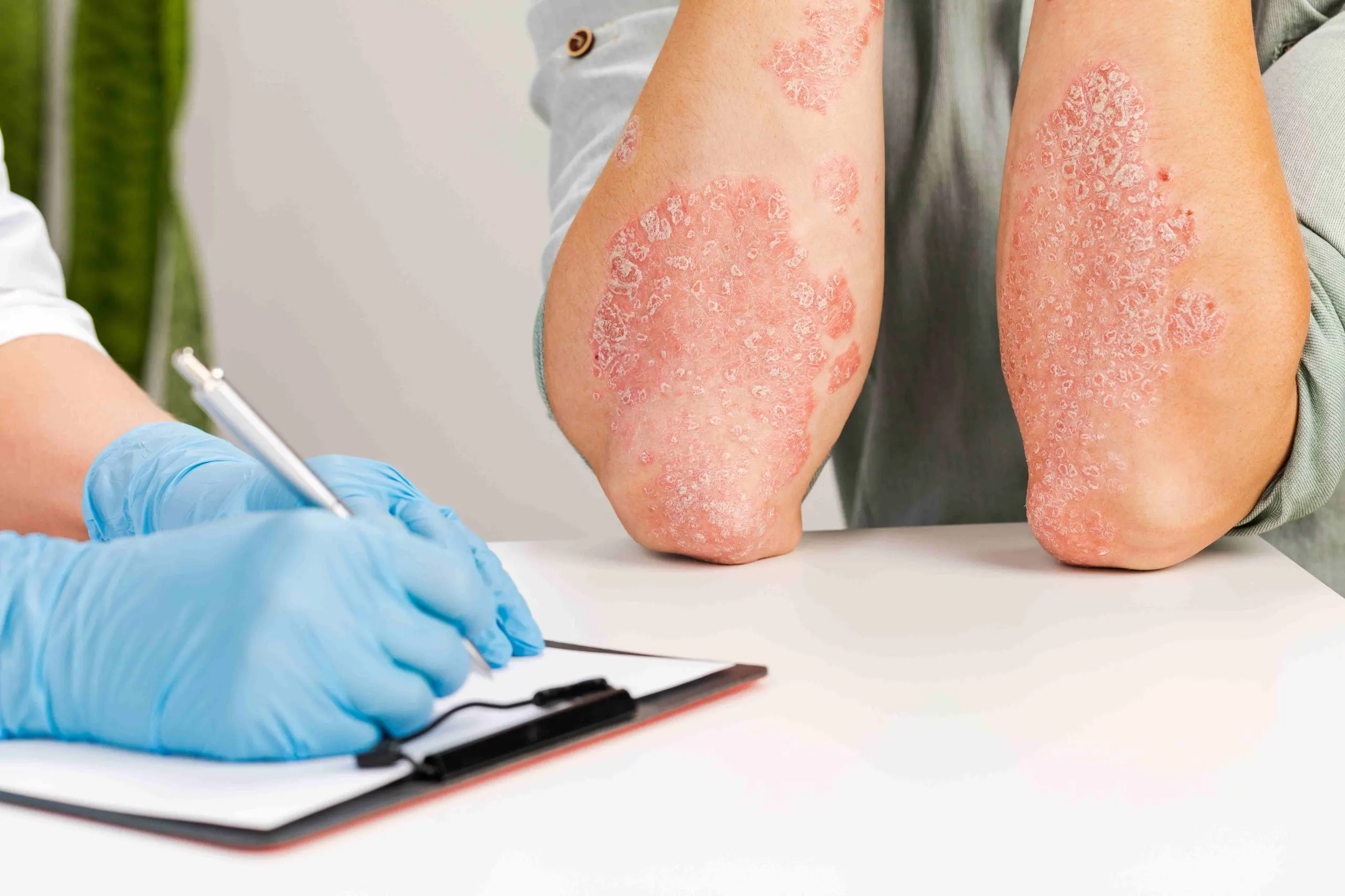 Philippines Systemic Lupus Erythematosus Testing Market Outlook 2030 gloved-dermatologist-examines-skin-sick-patient-records-observations-examination-diagnosis-skin-diseasesallergies-psoriasis-eczema-dermatitis_compressed-scaled