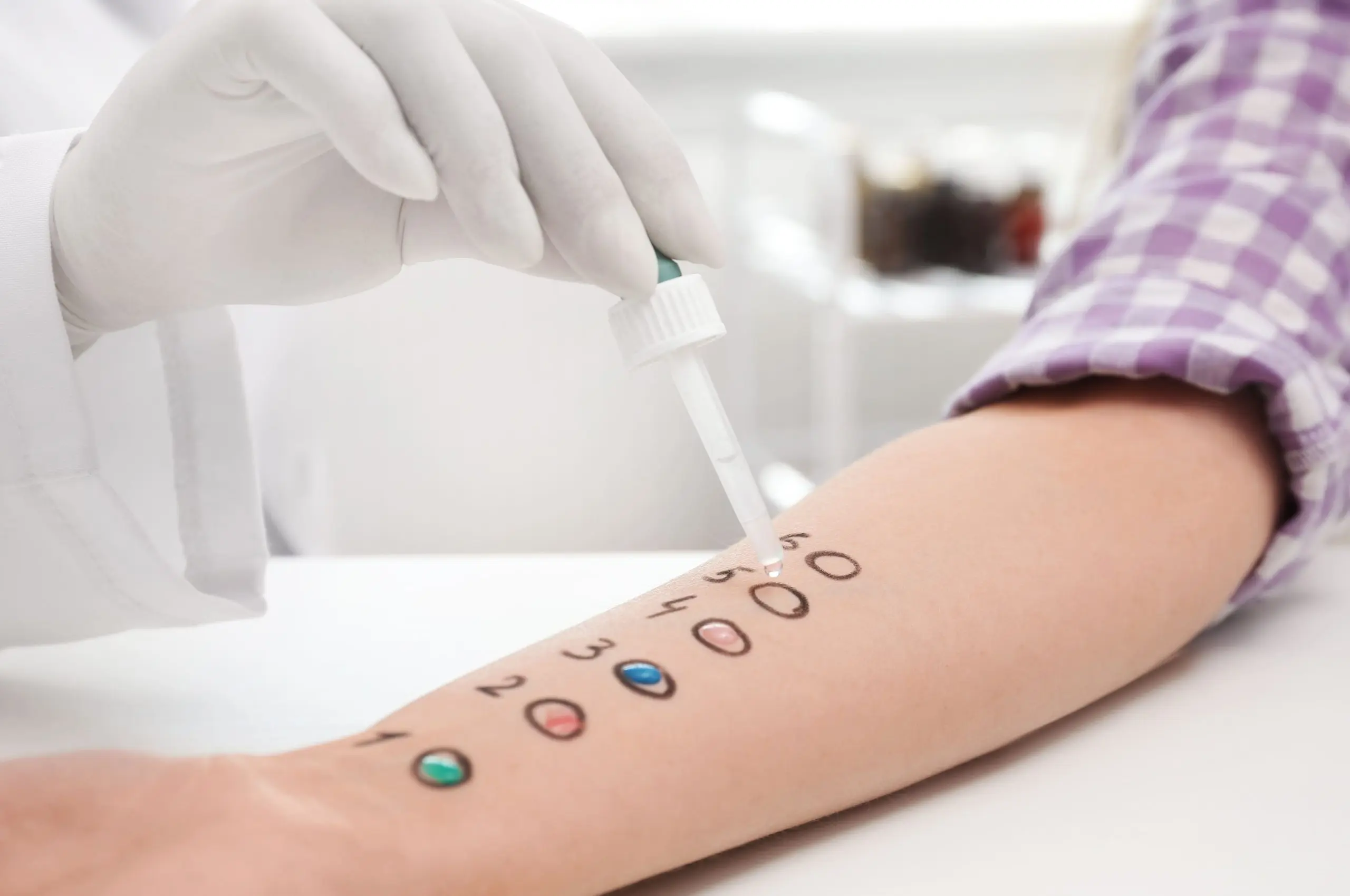 USA Systemic Lupus Erythematosus Testing Market Outlook 2030 patient-undergoing-skin-allergy-test-light-table-closeup-1-scaled