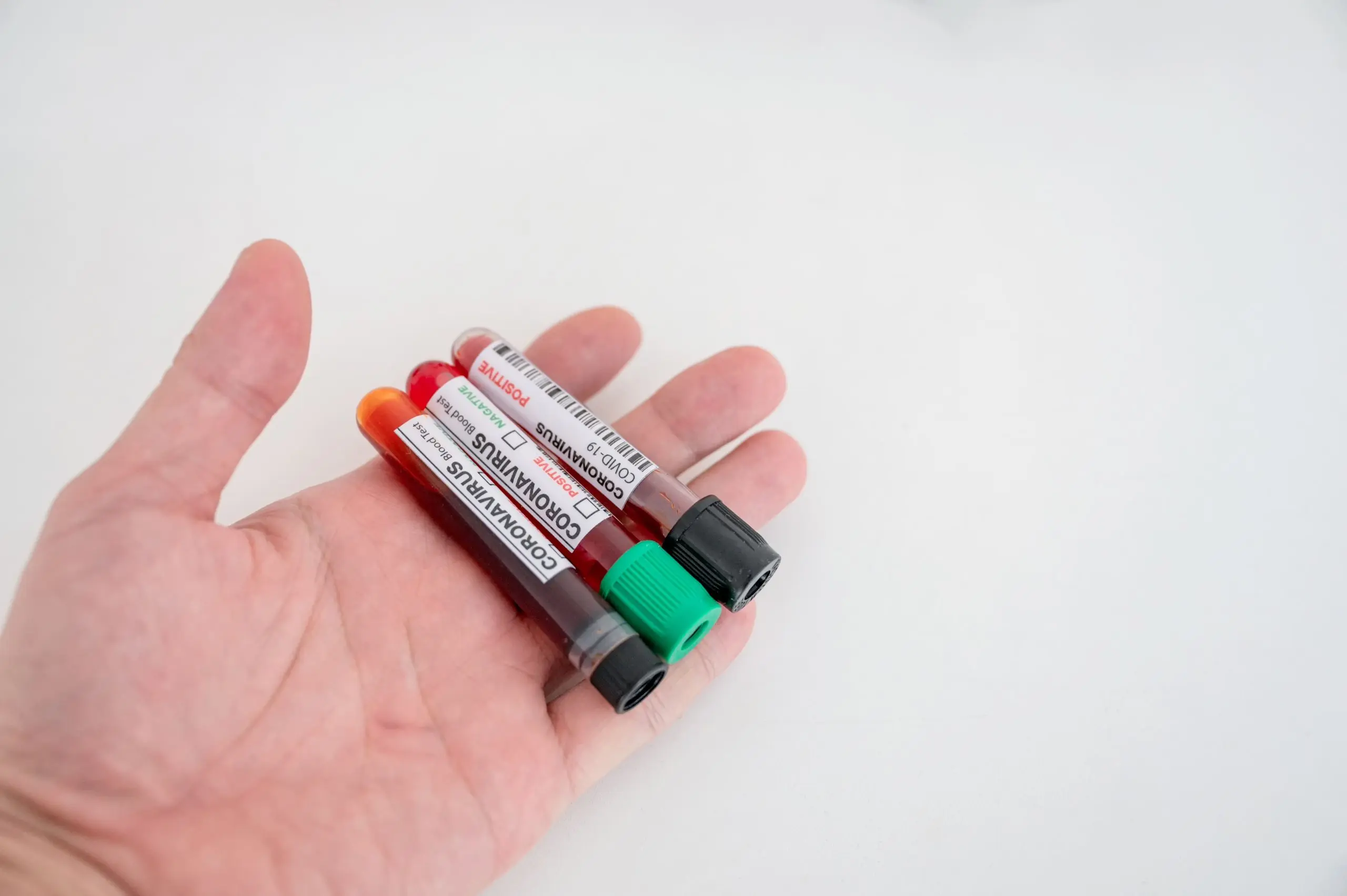 Philippines Blood Glucose Test Strips Market Outlook to 2030 sample-blood-test-tubes-chemist-palm-diagnosis-coronavirus-covid-19-infection-laboratory-1-scaled