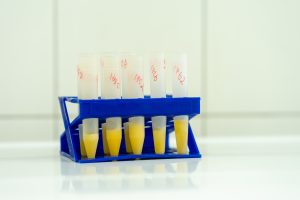 USA Urine Analyzers Equipment Market Outlook 2035